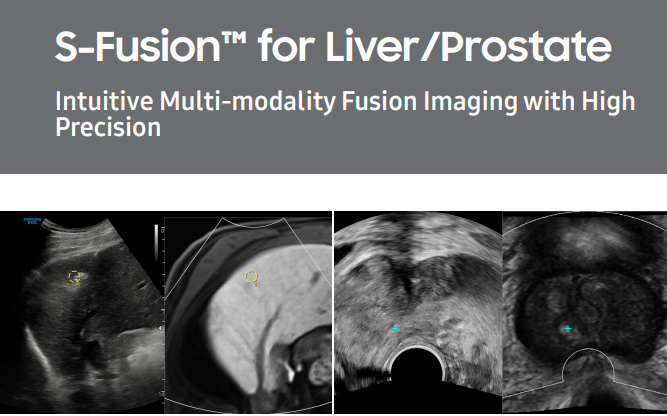 Report on S‑Fusion™ fusion imaging for liver and prostate cancer care