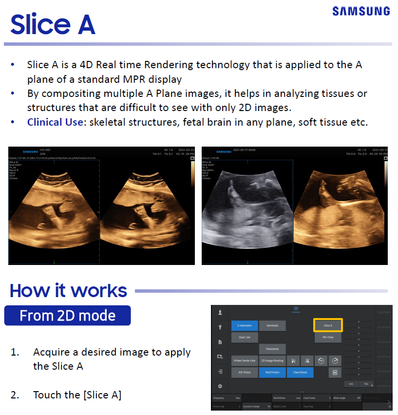 Quick Overview on Slice-A for fetal brain ultrasound and skeletal structure imaging