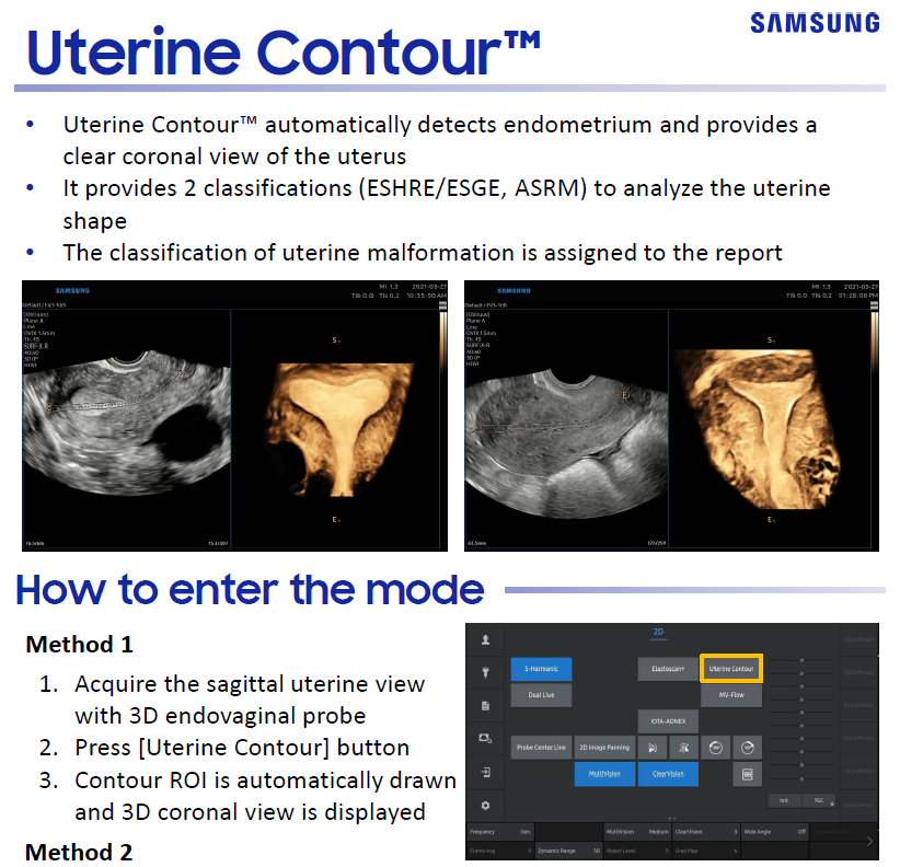 Quick Overview on UterineContour™ for automated endometrial ultrasound and uterine classification