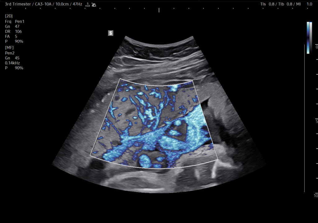 Ultrasound image of placenta with MV-Flow™ on HERA Z20 showing detailed placental vascularity and blood flow for obstetric evaluation