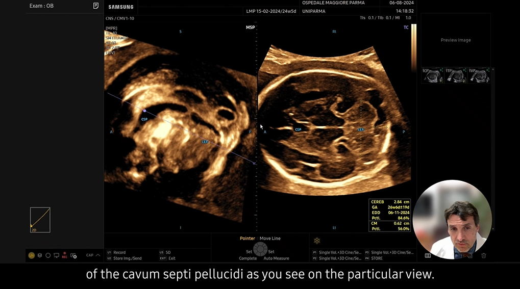 Webinar on antenatal ultrasound of fetal brain highlighting the added value of using the Z20 ultrasound machine presented by Prof. Tullio Ghi.