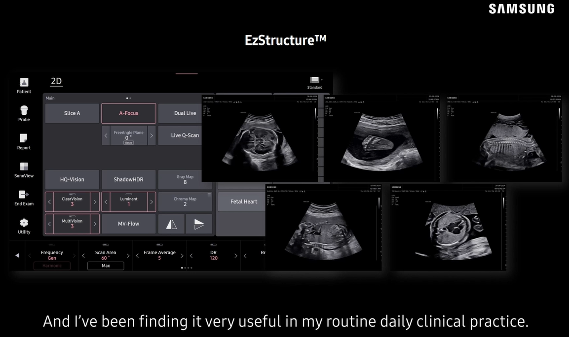 Webinar on fetal ultrasound using Samsung HERA Z20 for fetal heart and fetal brain ultrasound