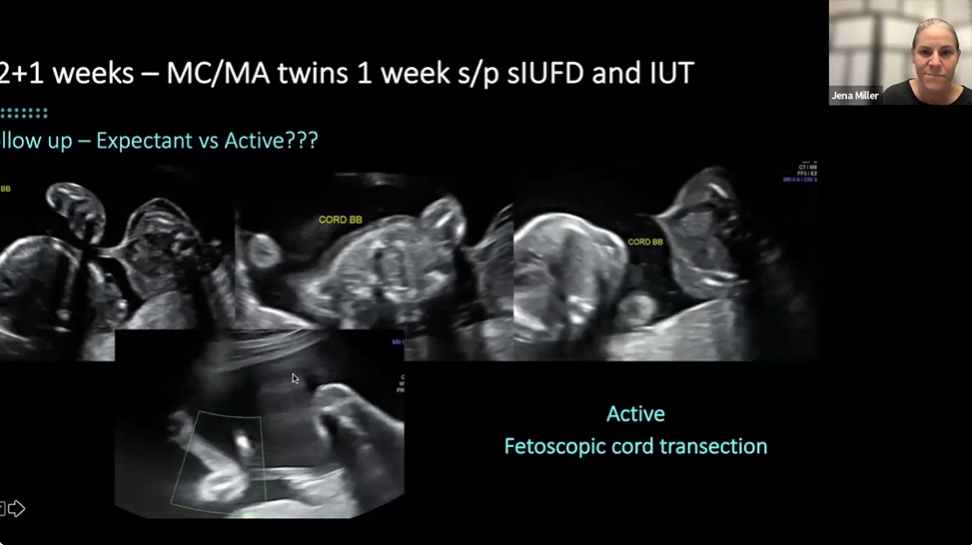 Webinar featuring challenge cases in fetal intervention for twin and multiple pregnancy moderated by Prof. Asma Khalil with diagnostic ultrasound examples.