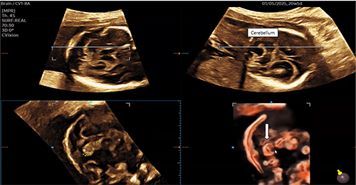 Webinar on fetal brain ultrasound imaging using CrystalVue™ technology