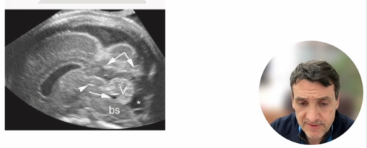 Webinar on fetal cerebellum and posterior fossa ultrasound evaluation