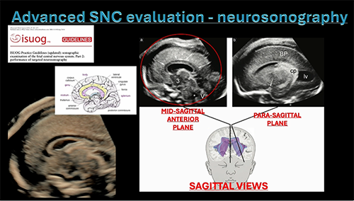 Webinar on detecting corpus callosum and cavum septum abnormalities via fetal brain ultrasound