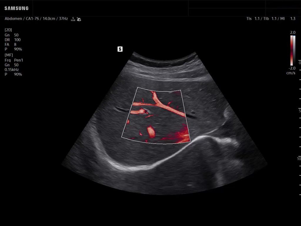 Hepatic vein ultrasound with MV-Flow on Samsung R20, subcostal view showing liver vascular imaging.