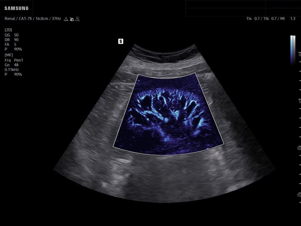 Renal microcirculation imaging with MV-Flow power mode showing enhanced kidney blood flow visualization in blue tone.