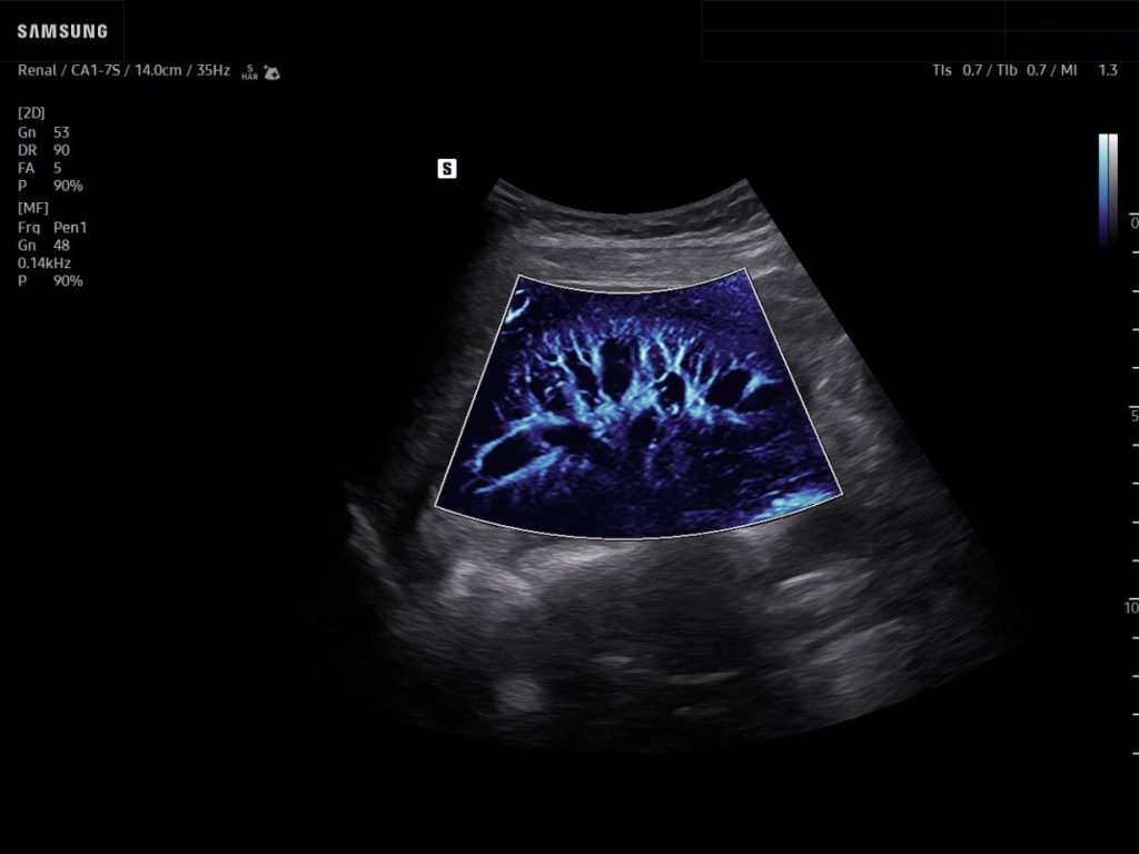 Kidney ultrasound with MV-Flow on Samsung R20 showing microvascular blood flow visualization.
