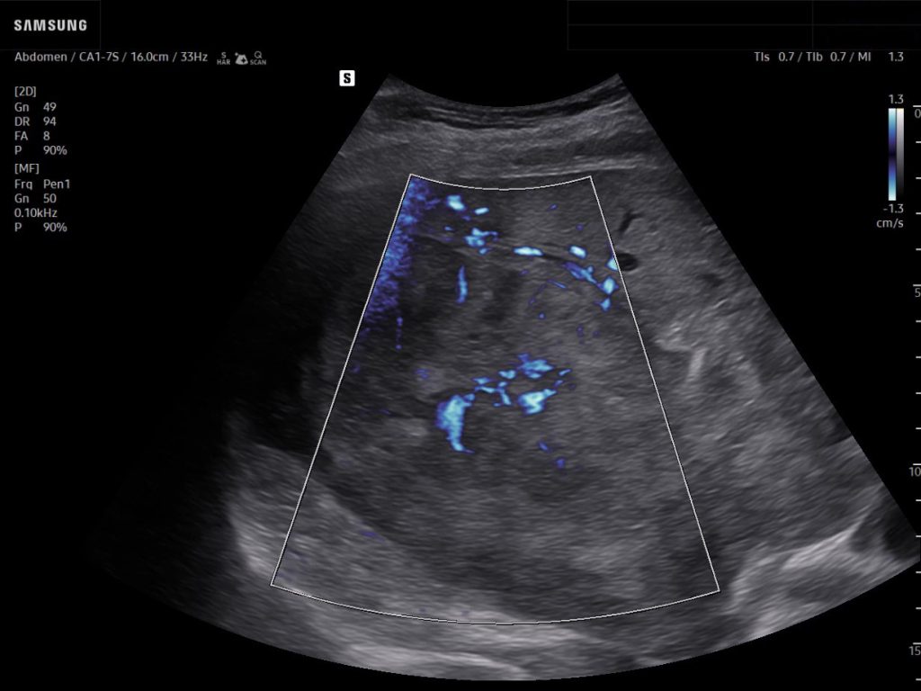 Ultrasound imaging on liver cancer ultrasound showing a large hepatic tumor with internal vascular flow patterns using MV-Flow™