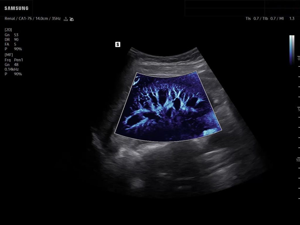 Kidney ultrasound with MV-Flow showing renal blood flow and microvascular perfusion