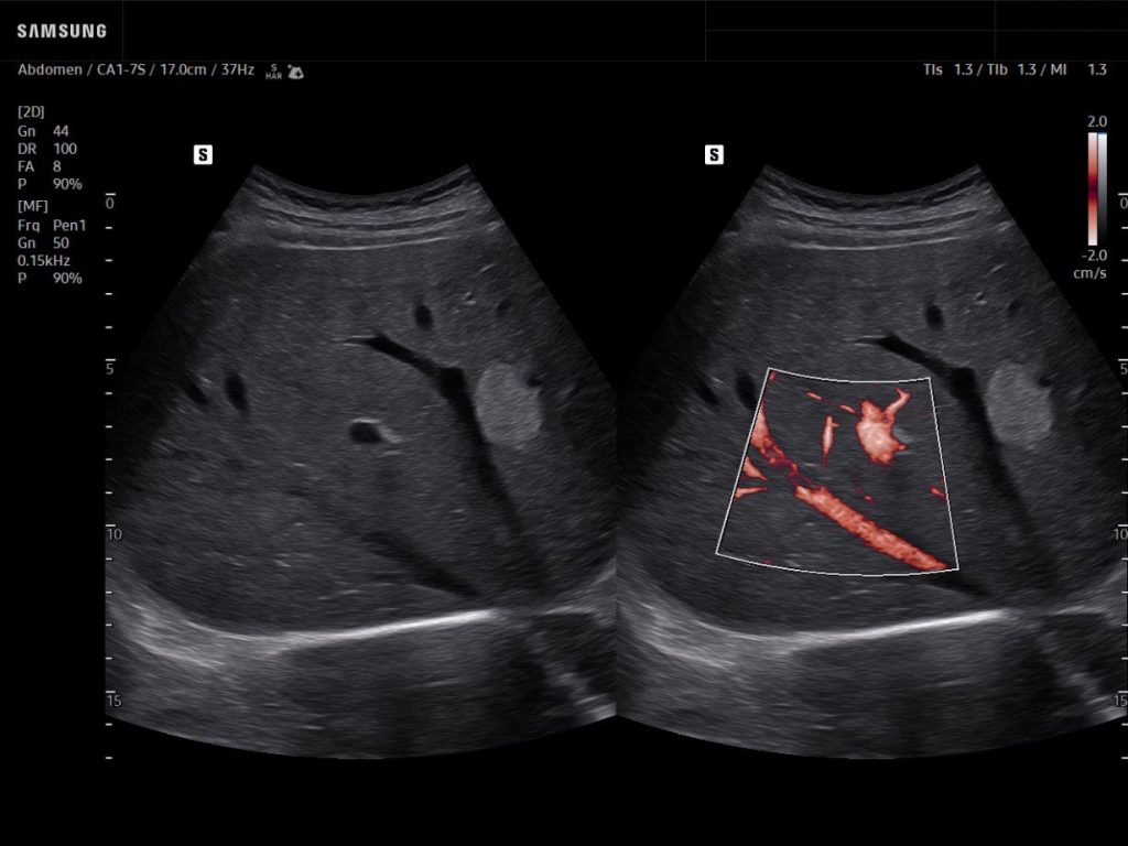 Liver ultrasound showing blood flow in a hepatic hemangioma with MV-Flow and LumiFlow in red tone