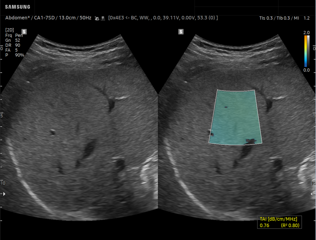 Liver with QUS (TAI™TSI™)