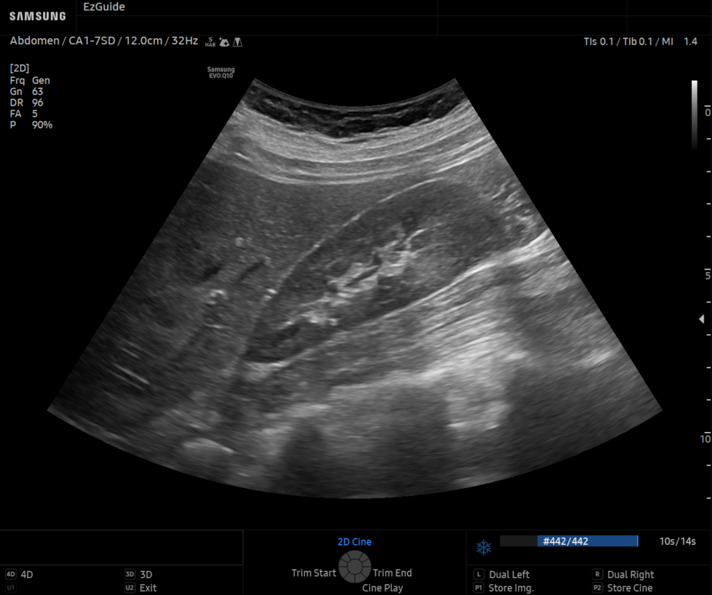 EzGuide for right upper quadrant (eFAST) with Q10