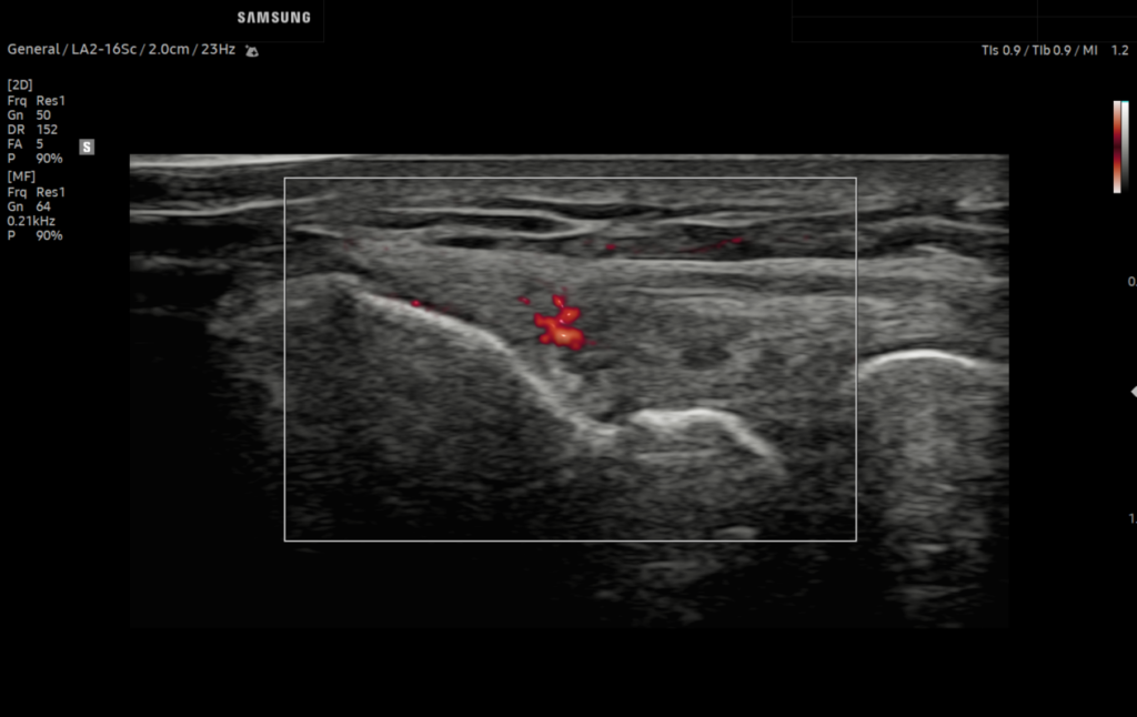 Lateral elbow with MV-Flow™ on Q10