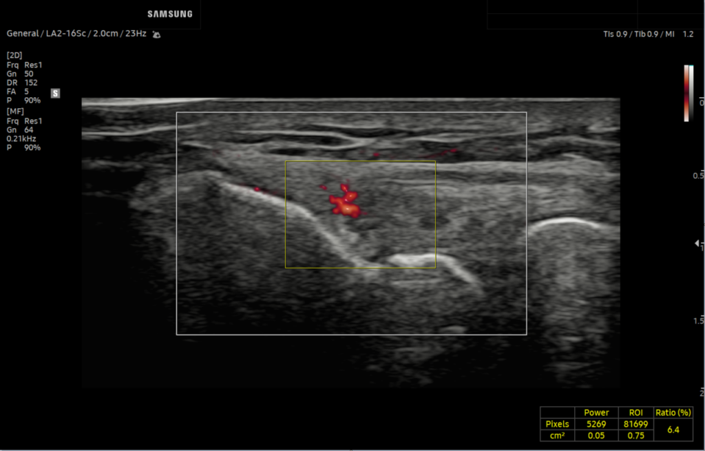 Lateral elbow with Vascularity Index in MV-Flow™ on Q10