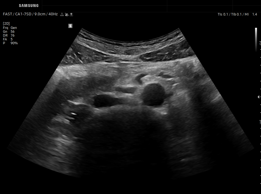 EzStructure ON_Aorta
