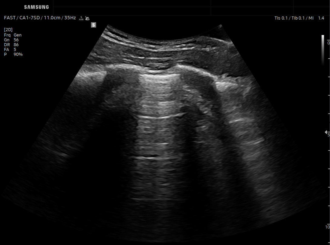 EzStructure ON_Lung