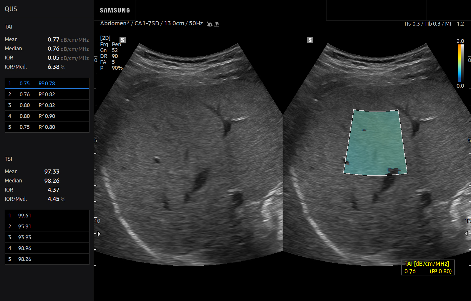 Abdomen ultrasound image of Liver using QUS(TAI) feature – Samsung EVO Q10