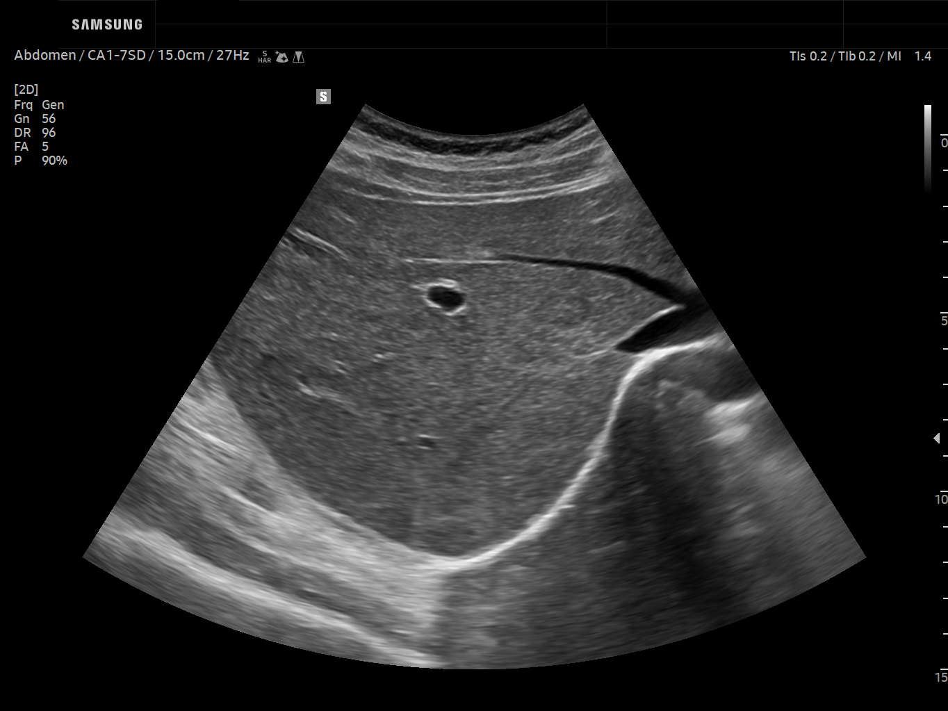 Abdomen ultrasound image of Liver Hemangioma in 2D – Samsung EVO Q10