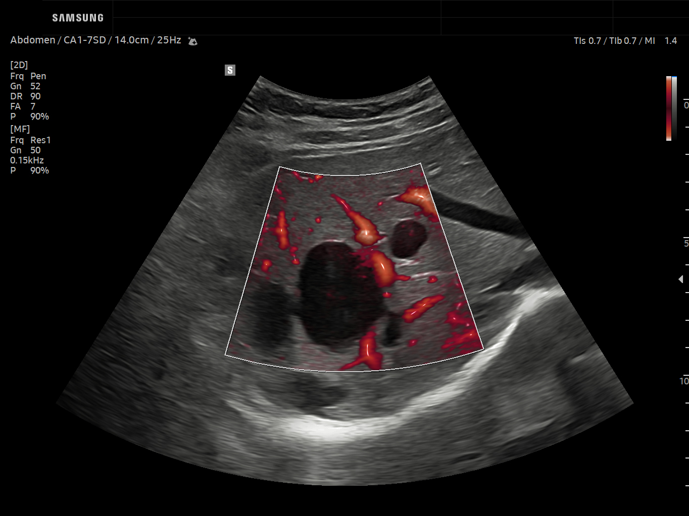 Abdomen ultrasound image of Multiple Hepatic Cysts using LumiFlow™ feature – Samsung EVO Q10