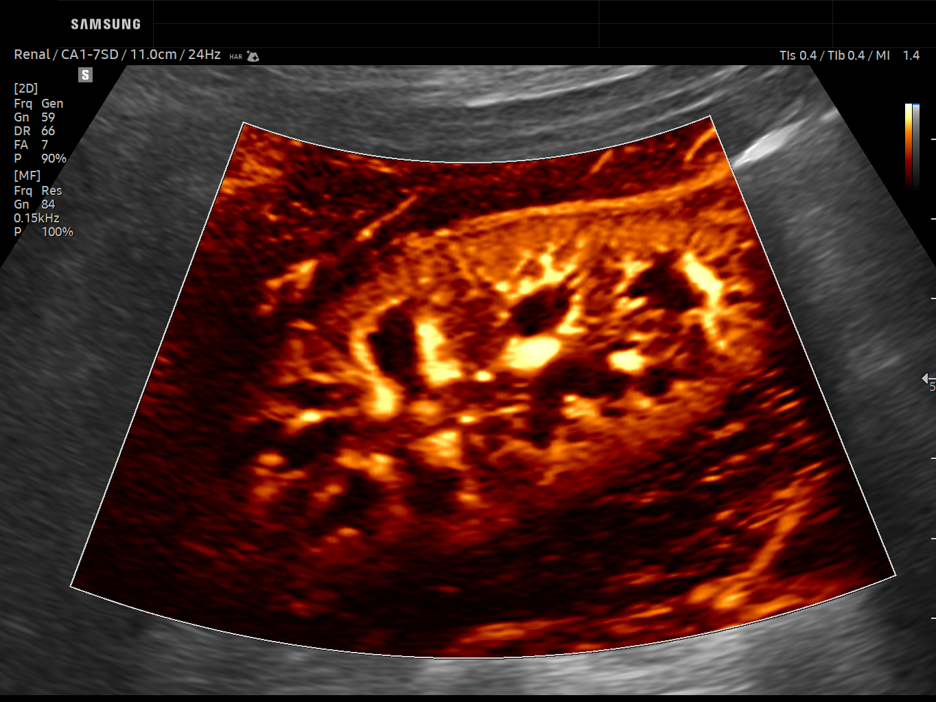 Abdomen ultrasound image of Renal Microvascular Flow using MV-Flow™ feature – Samsung EVO Q10