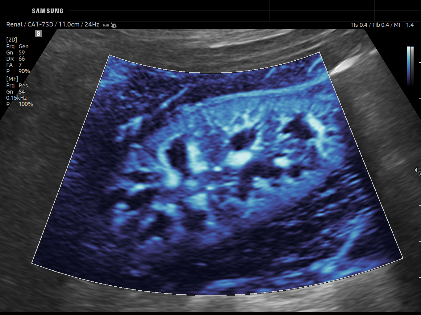 Abdomen ultrasound image of Renal Microvascular Flow using MV-Flow™ feature – Samsung EVO Q10