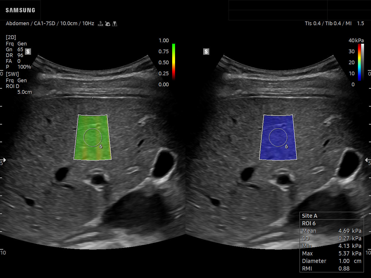 Abdomen ultrasound image of Liver using S-Shearwave feature - Samsung EVO Q10