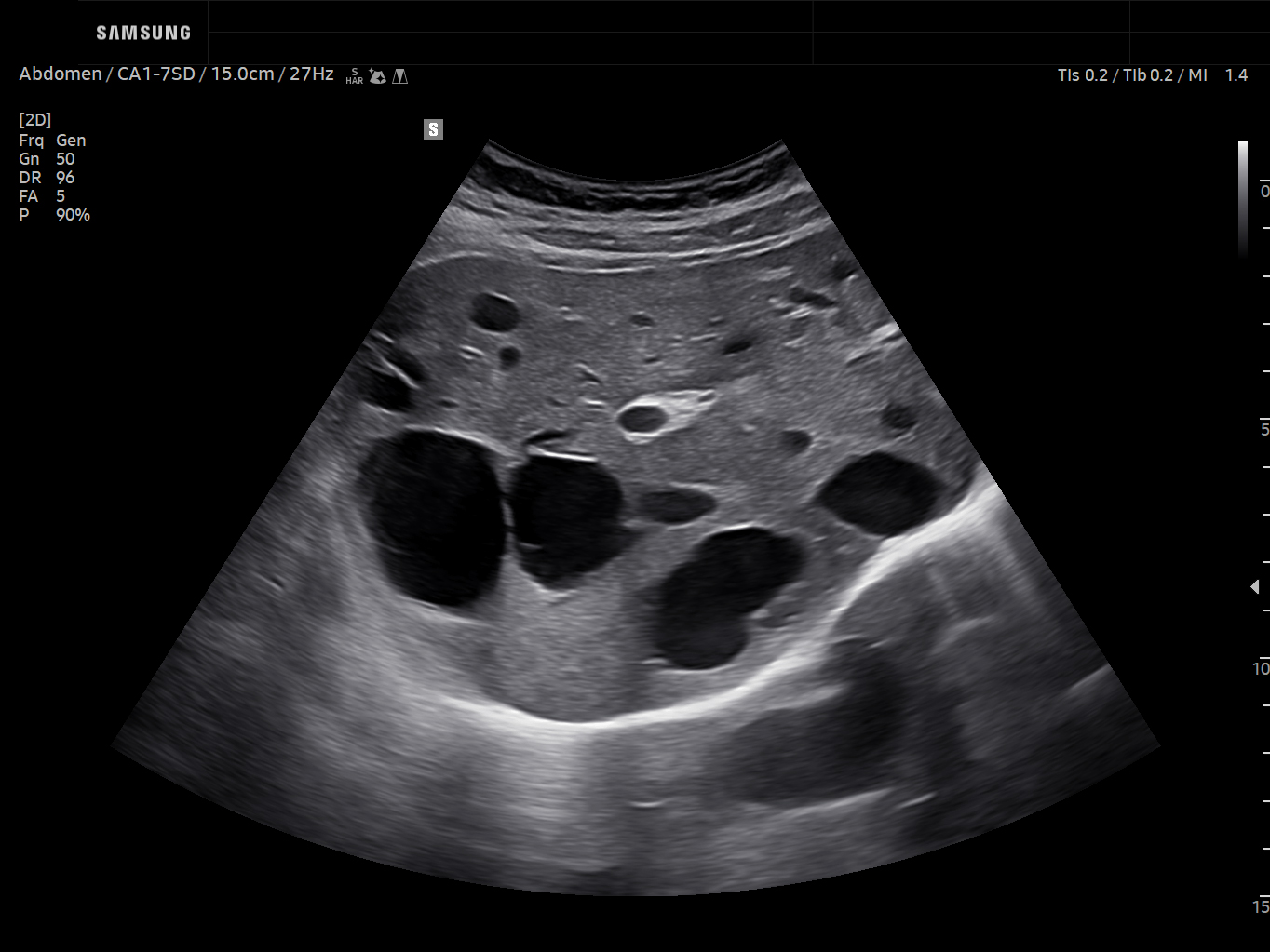 Abdomen ultrasound image of Multiple Cystic Lesions in the Liver - Samsung EVO Q10