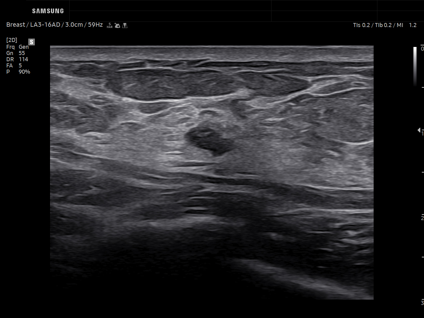 Breast ultrasound image of Breast lesion in 2D – Samsung EVO Q10