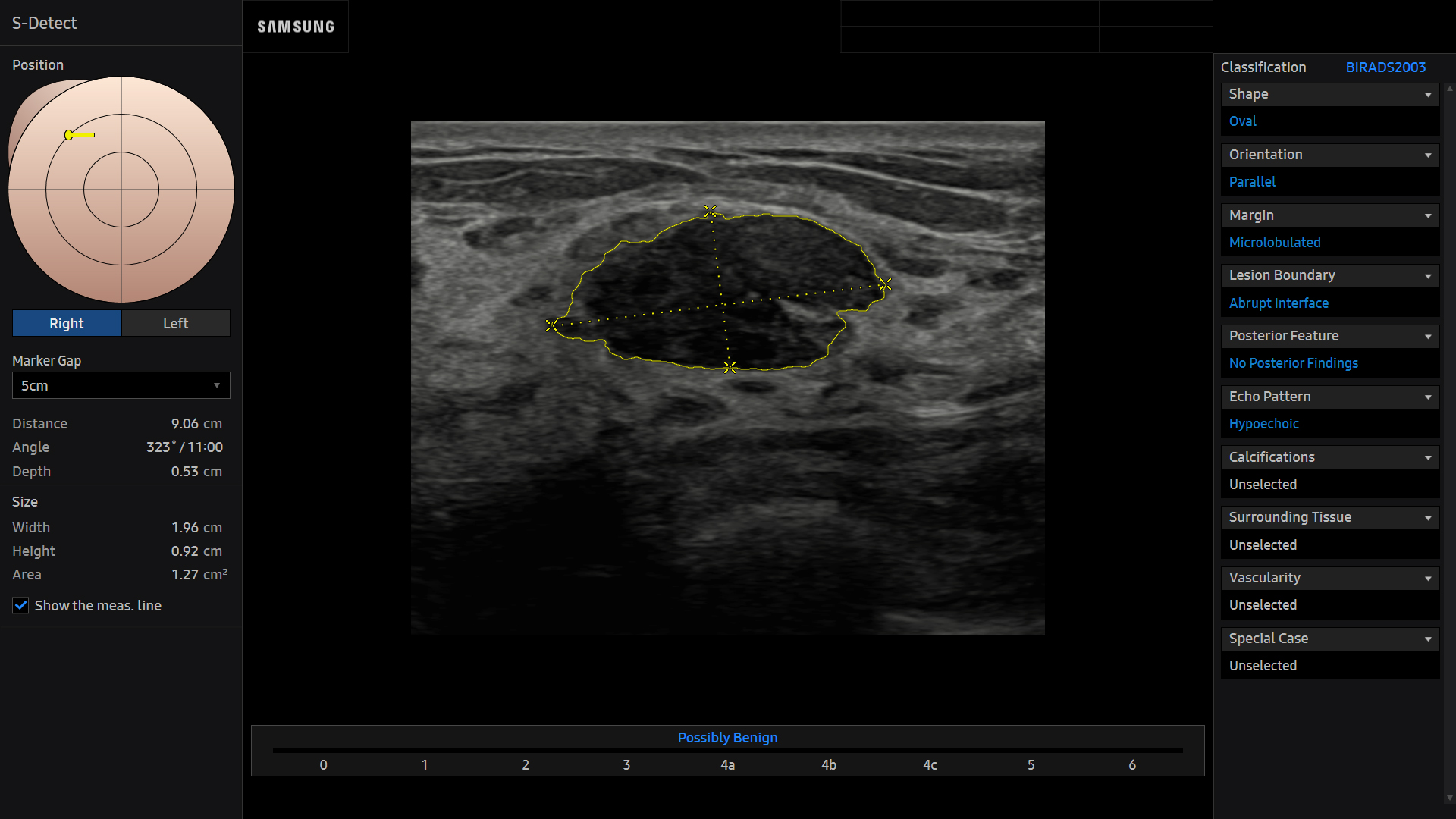 Breast ultrasound image of Breast Fibroadenoma using S-Detect for Breast™ feature – Samsung EVO Q10