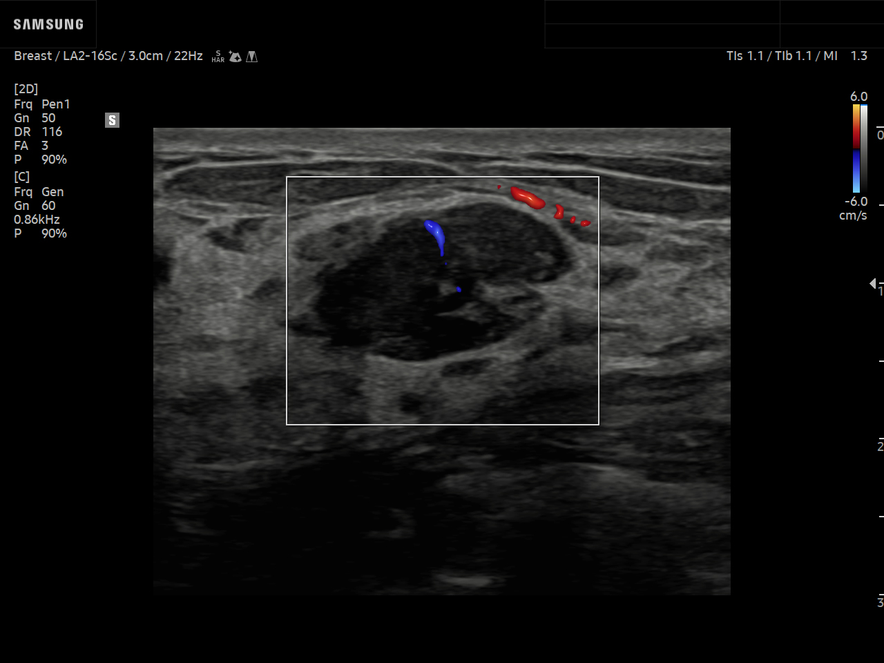 Breast ultrasound image of Breast Fibroadenoma using LumiFlow™ feature – Samsung EVO Q10