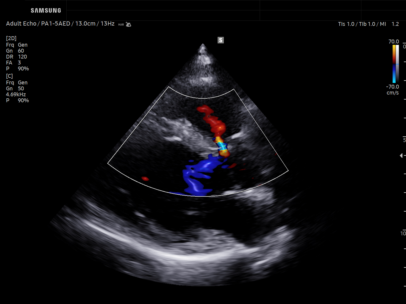 Cardiac ultrasound image of VSD in PLAX using LumiFlow™ feature – Samsung EVO Q10
