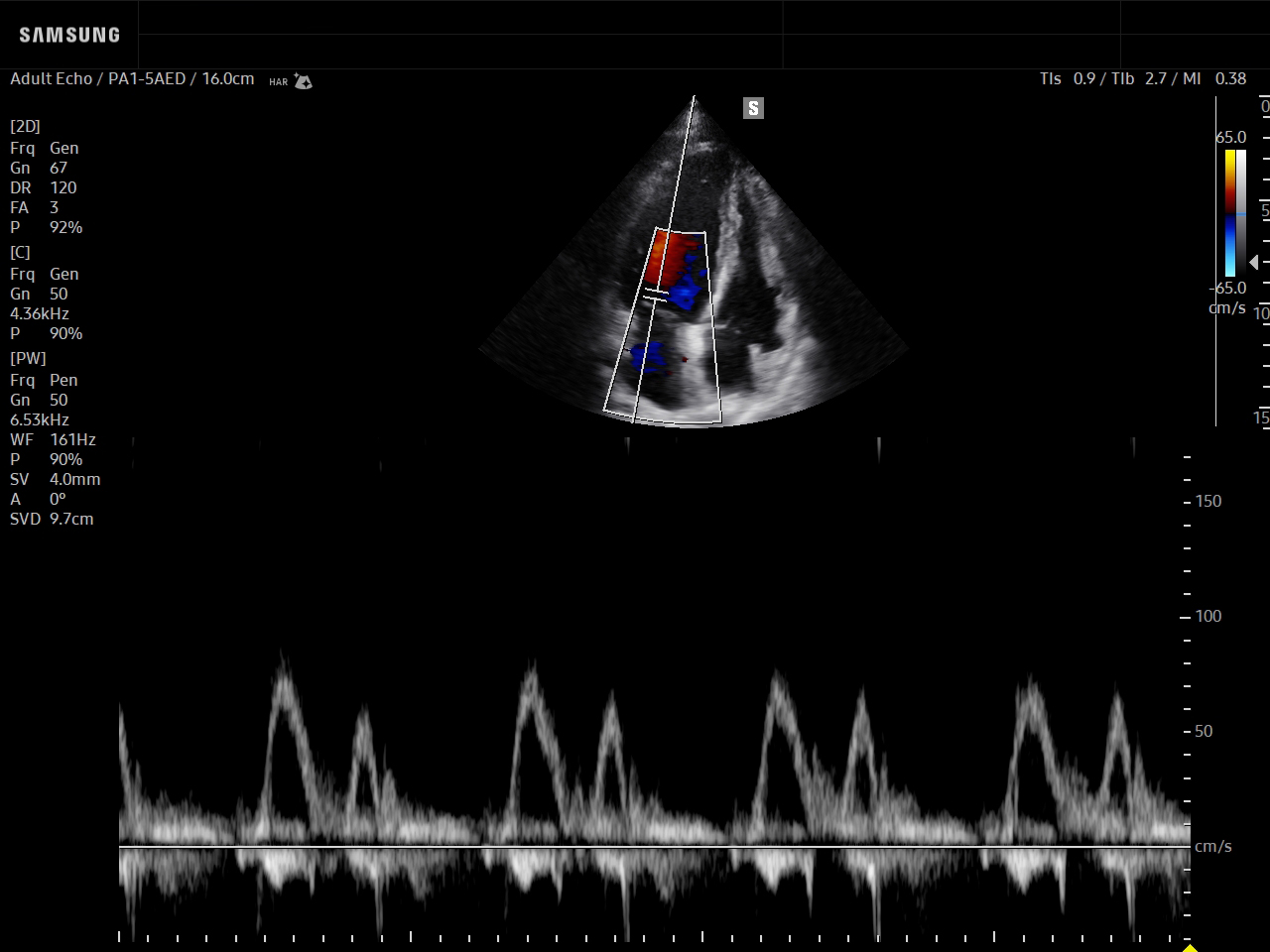 Cardiac ultrasound image of MV Inflow with PW – Samsung EVO Q10