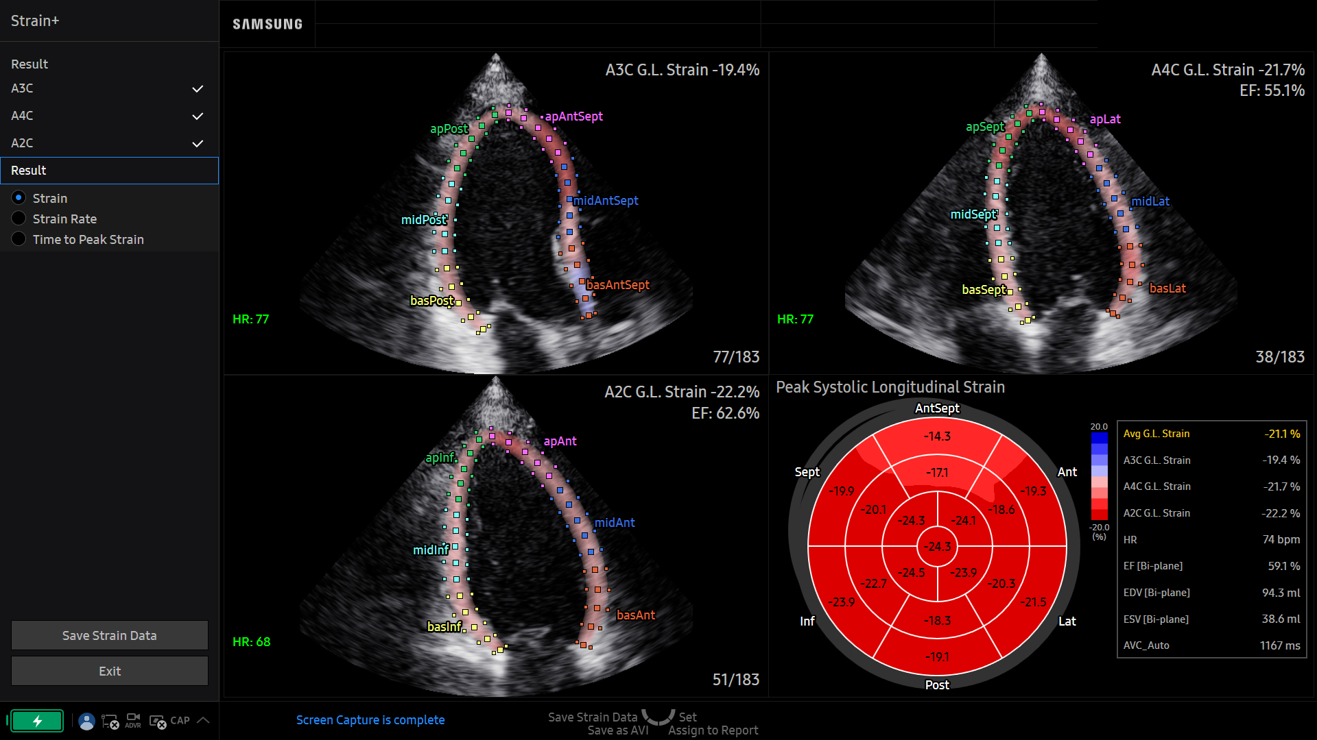 Cardiac ultrasound image of Left Ventricle using Strain+ feature – Samsung EVO Q10
