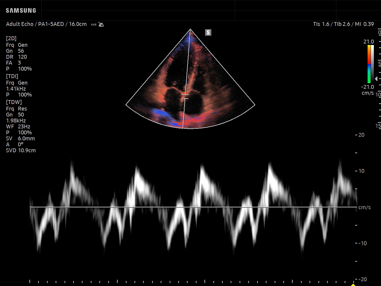 Cardiac ultrasound image of Septal Mitral Annular Velocity using TDI feature – Samsung Medison Q10