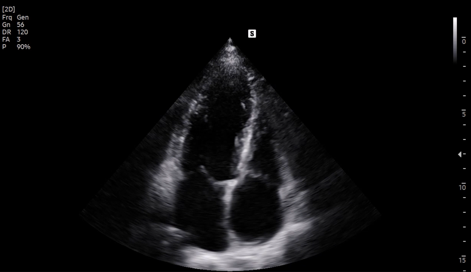 Cardiac ultrasound image of A4C View in 2D - Samsung EVO Q10