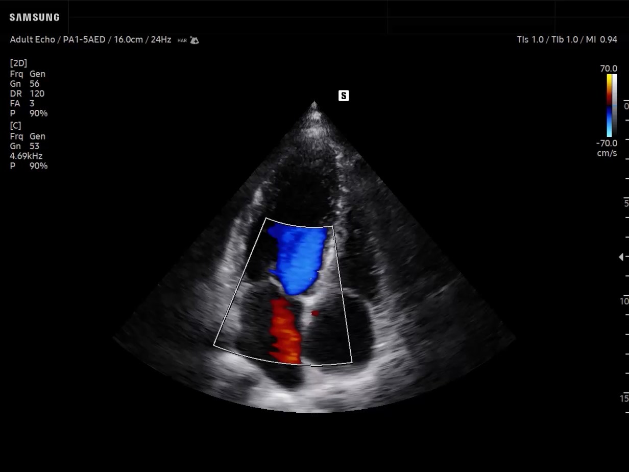 Cardiac ultrasound image of A4C View in Color Doppler - Samsung EVO Q10