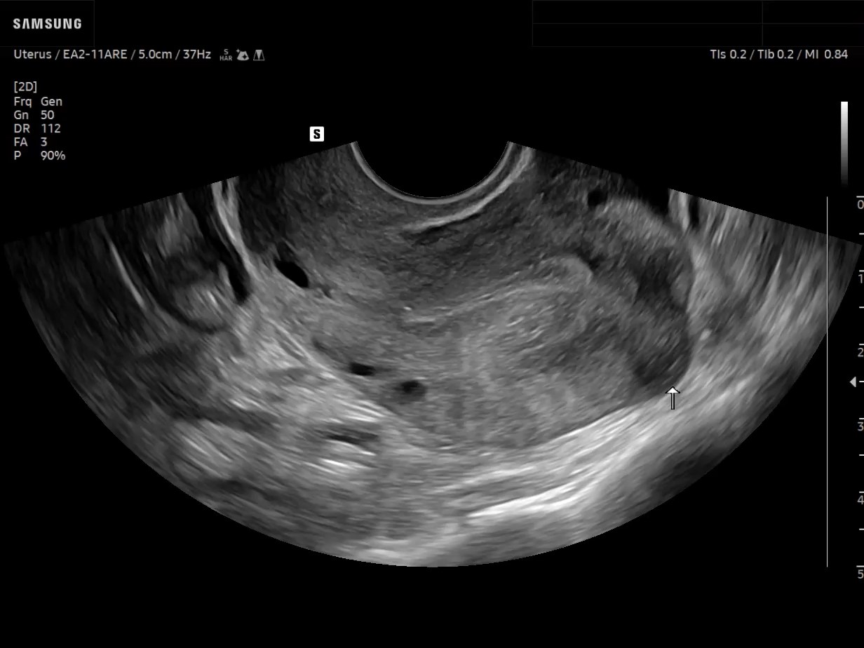 GYN ultrasound image of Uterine Fibroid in 2D - Samsung EVO Q10