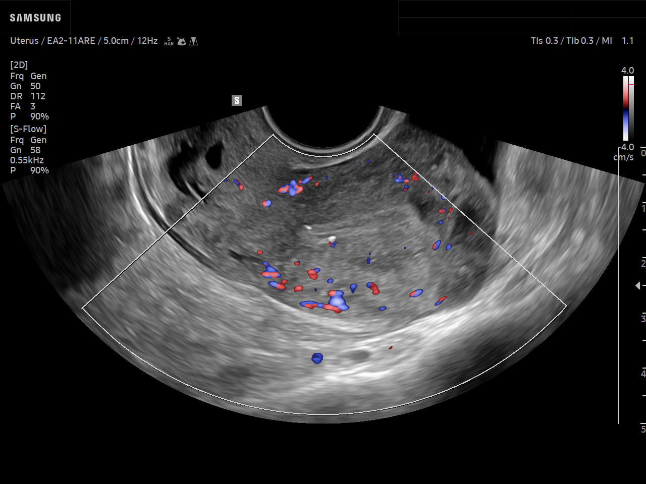 GYN ultrasound image of Uterine Fibroid using S-Flow™ feature – Samsung EVO Q10