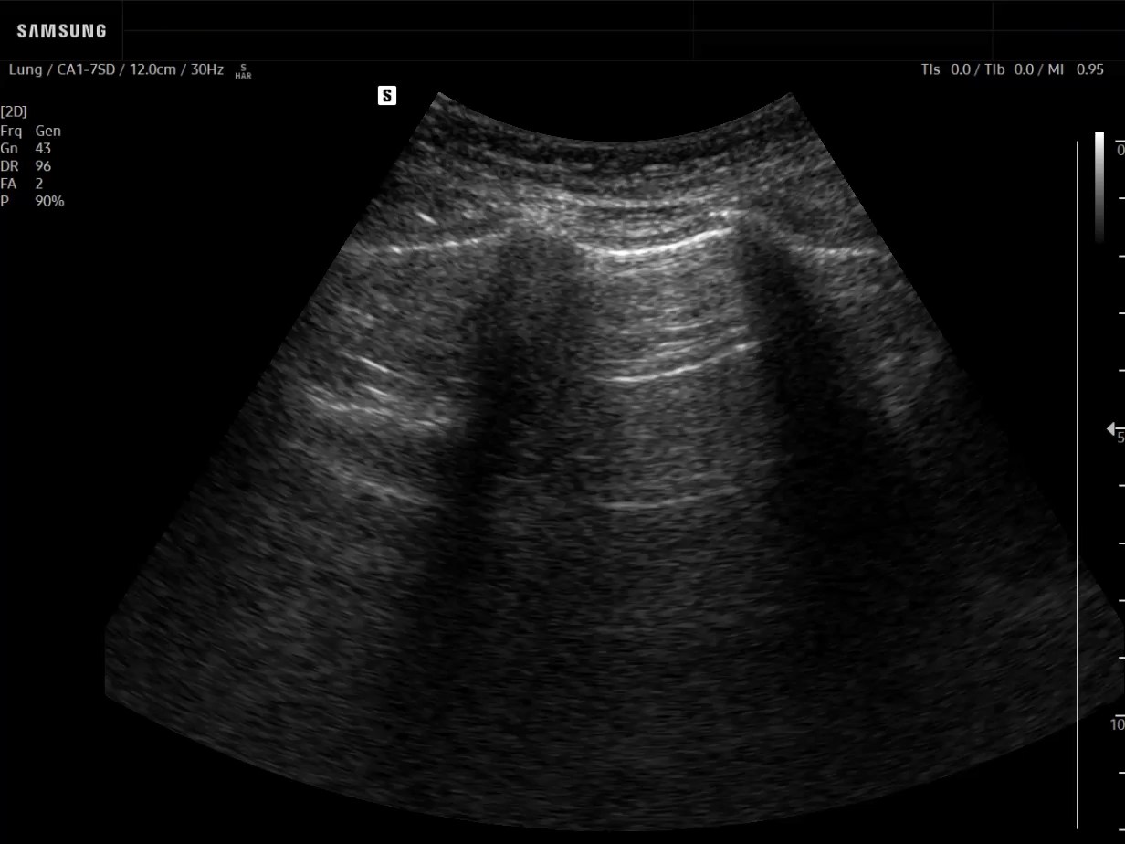 Lung ultrasound image of A-lines in 2D - Samsung EVO Q10