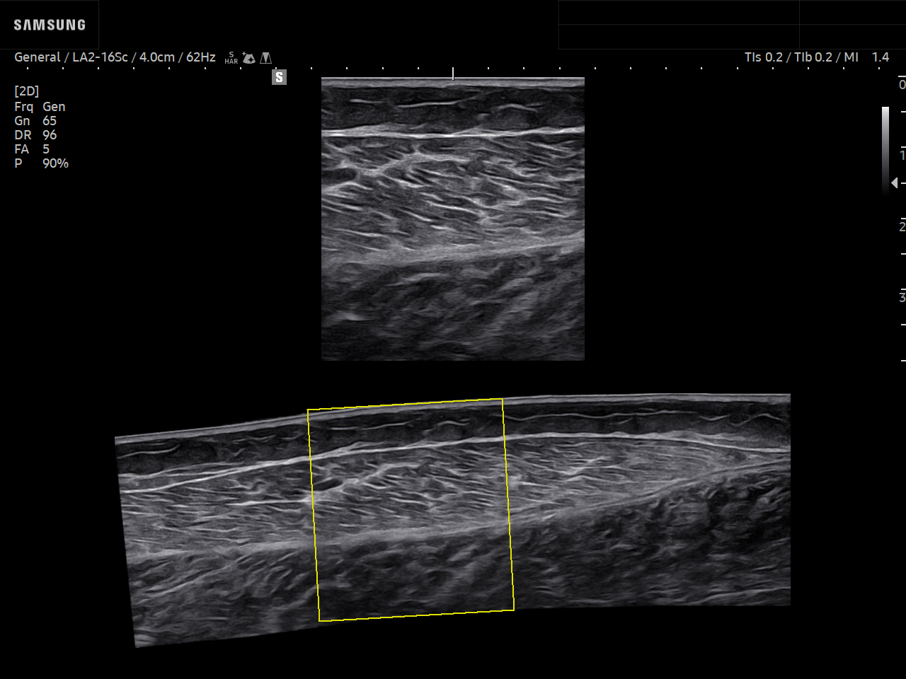 MSK ultrasound image of Calf using Panoramic+ feature – Samsung EVO Q10