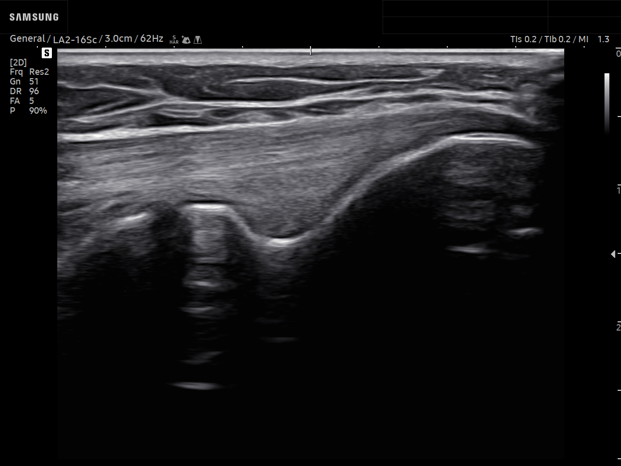 MSK ultrasound image of Elbow – Common extensor tendon of the lateral elbow – Samsung EVO Q10