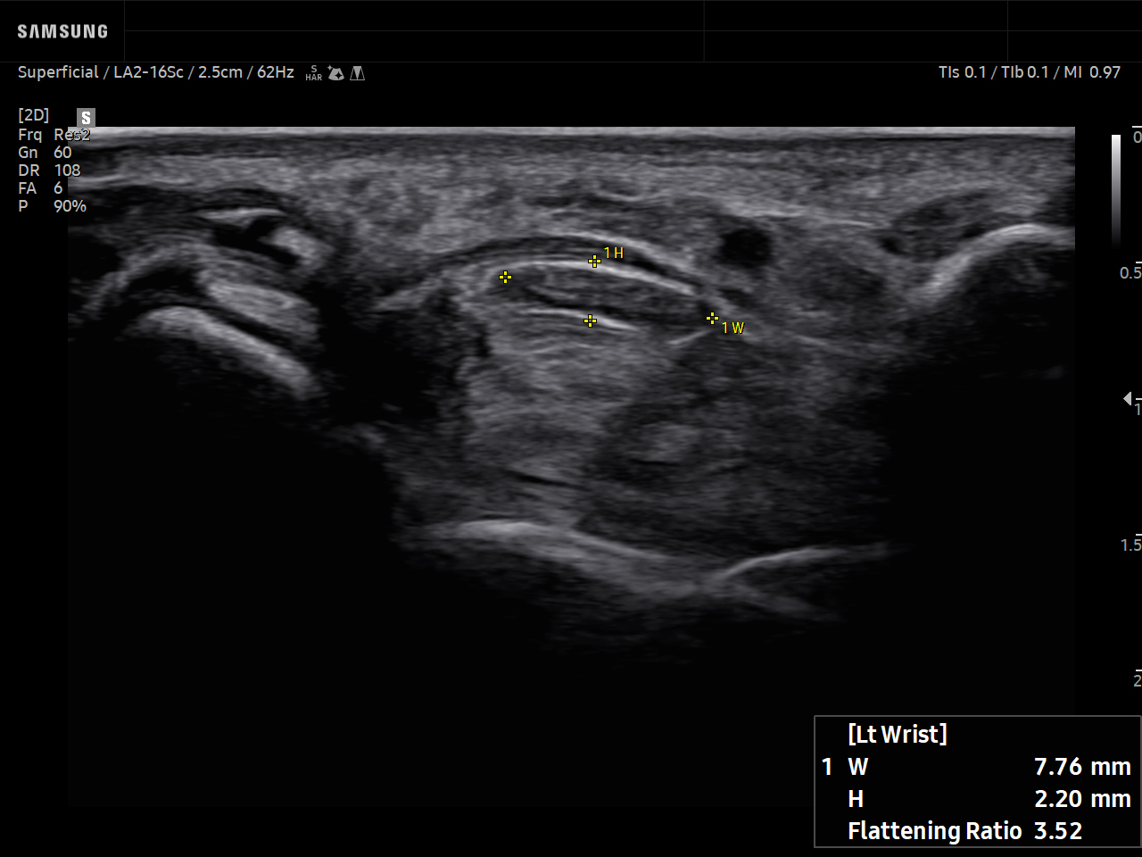 MSK ultrasound image of Wrist Median Nerve Flattening Ratio using EzNerveMeasure™ feature – Samsung EVO Q10