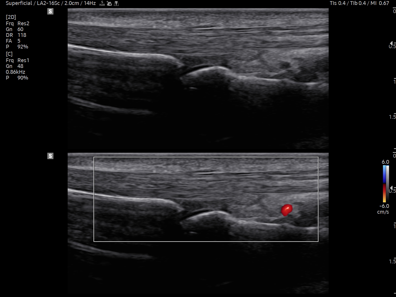 MSK ultrasound image of Finger A1 Pulley with DualLive – Samsung EVO Q10