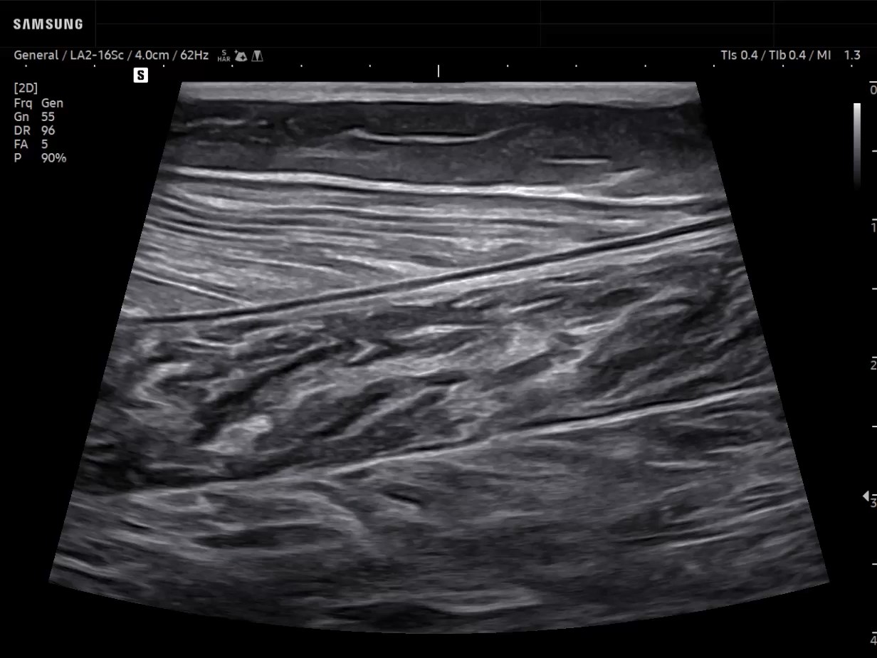 MSK ultrasound image of Calf - Trapezoidal Imaging for Medial head of the gastrocnemius - Samsung EVO Q10
