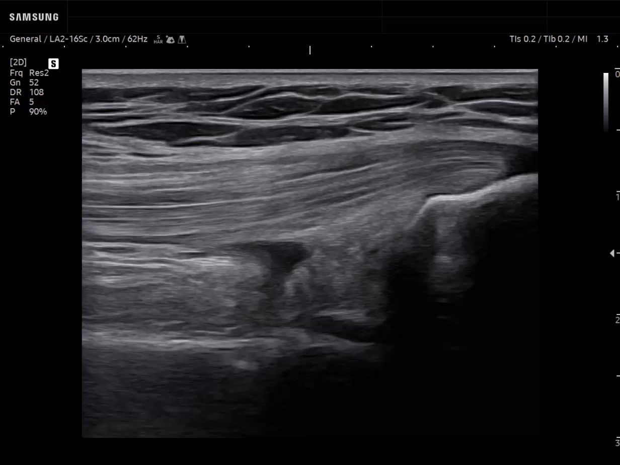 MSK ultrasound image of Knee - Quadriceps tendon in Suprapatellar Recess in 2D - Samsung EVO Q10