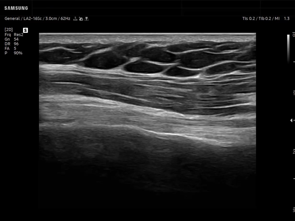 MSK ultrasound image of Shoulder - Biceps tendon Long axis in 2D - Samsung EVO Q10