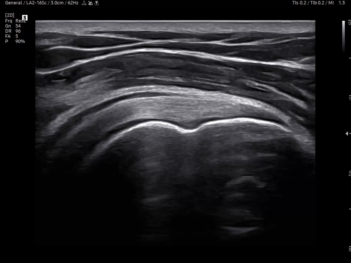 MSK ultrasound image of Shoulder - Supraspinatus tendon Long-axis in 2D - Samsung EVO Q10