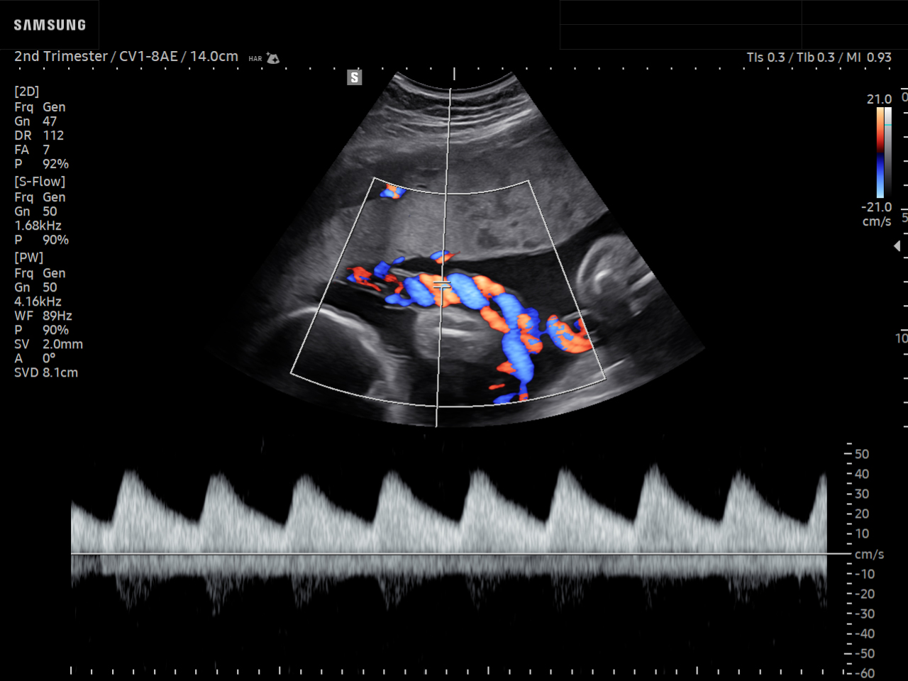 OB ultrasound image of Umbilical Artery with PW Doppler – Samsung EVO Q10